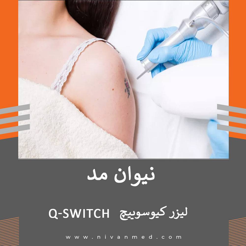 لیزر کیوسوییچ